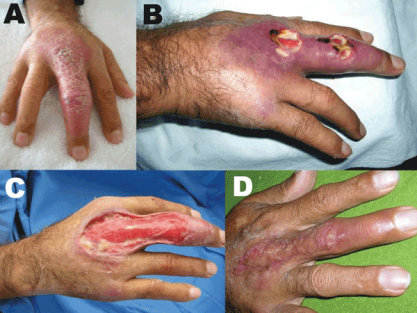 Buruli ulcer hand Peru